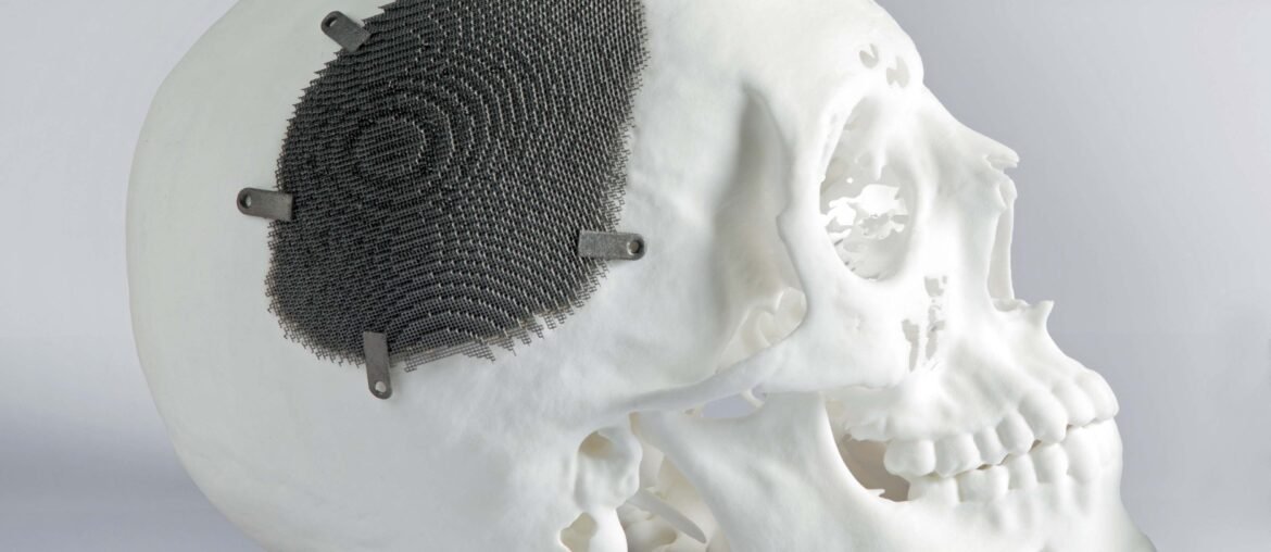 Even in your skull, polymers are needed