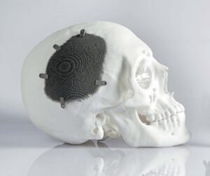 Even in your skull, polymers are needed