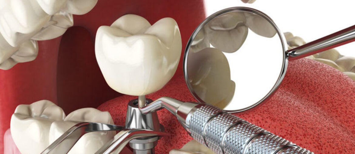 Dental implant using biodegradable polymer