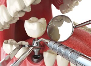 Dental implant using biodegradable polymer