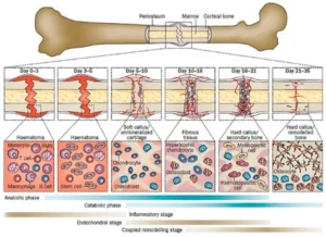 Australia Biodegradable Bone