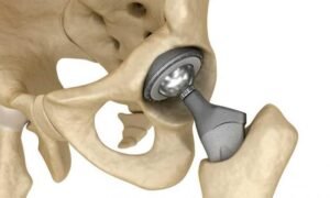 North America Biodegradable Bone