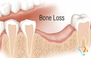 Malaysia Biodegradable Bone