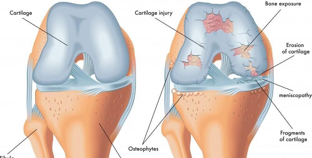 Osteoarthritis