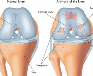 Osteoarthritis