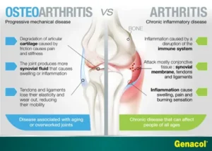 Osteoarthritis