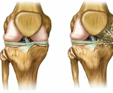 Osteoarthritis